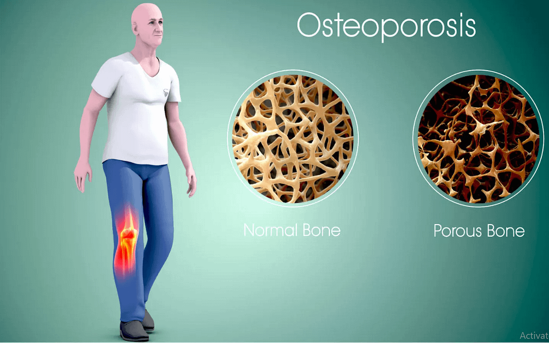 LET’S PREVENT AND REVERSE OSTEOPOROSIS WITH MEDICAL NUTRITON THERAPY